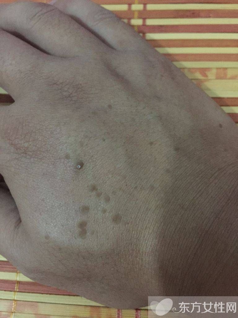 年轻人手上老年斑的原因