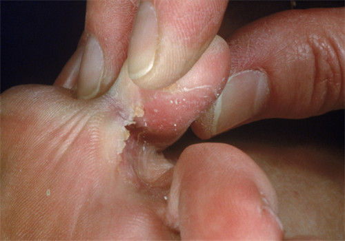 脚气产生的原因 去除脚气小编有办法