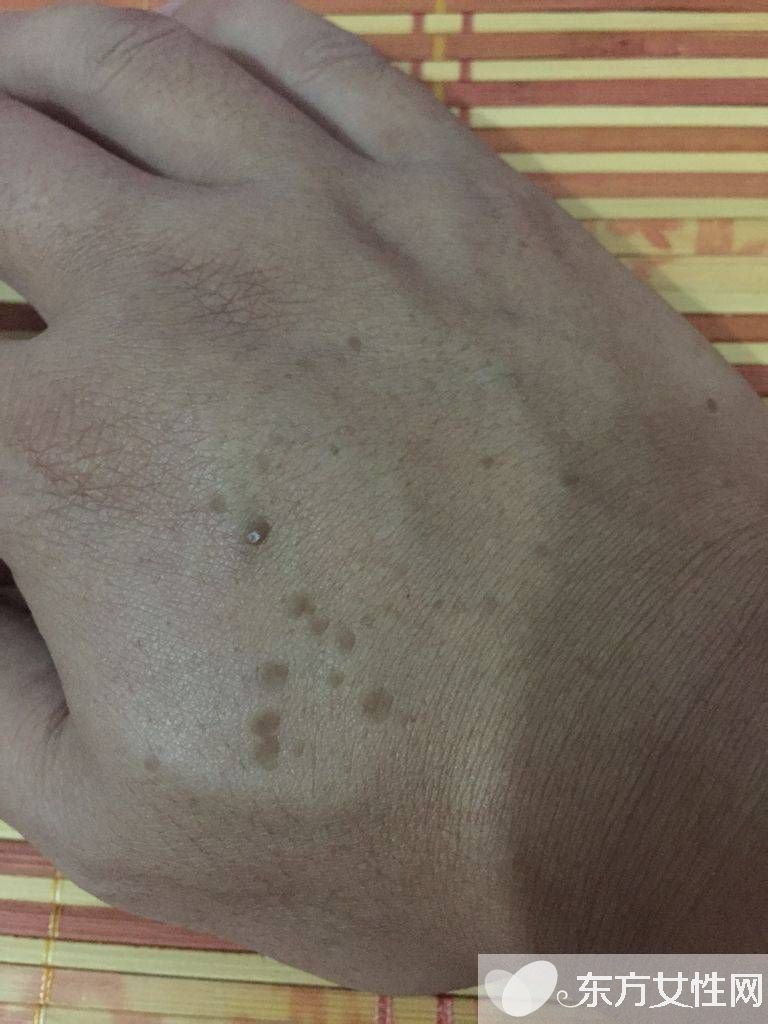 年轻人手上老年斑的原因