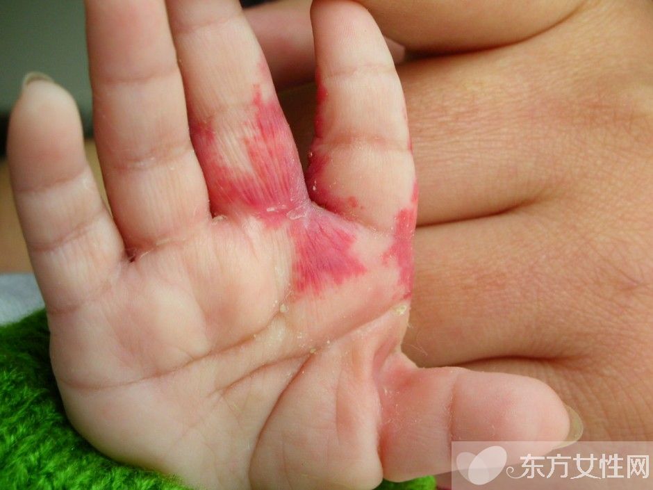 胎记怎么去除 激光去胎记的5大优势