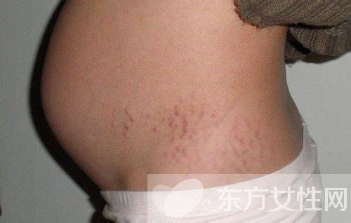 如何预防妊娠纹 最经济有效的祛除妊娠纹方法推荐