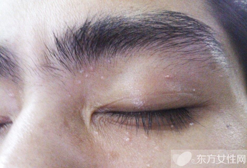 脂肪粒怎么去除小窍门 脂肪粒居然是这么来的