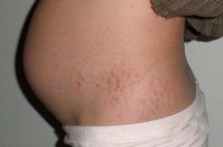 如何预防妊娠纹 最经济有效的祛除妊娠纹方法推荐