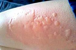 海鲜过敏怎么办 预防海鲜过敏的方法