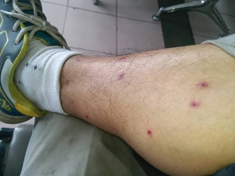 海鲜过敏怎么办 预防海鲜过敏的方法