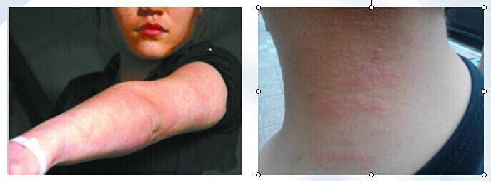 紫外线过敏怎么办 它有哪些症状表现