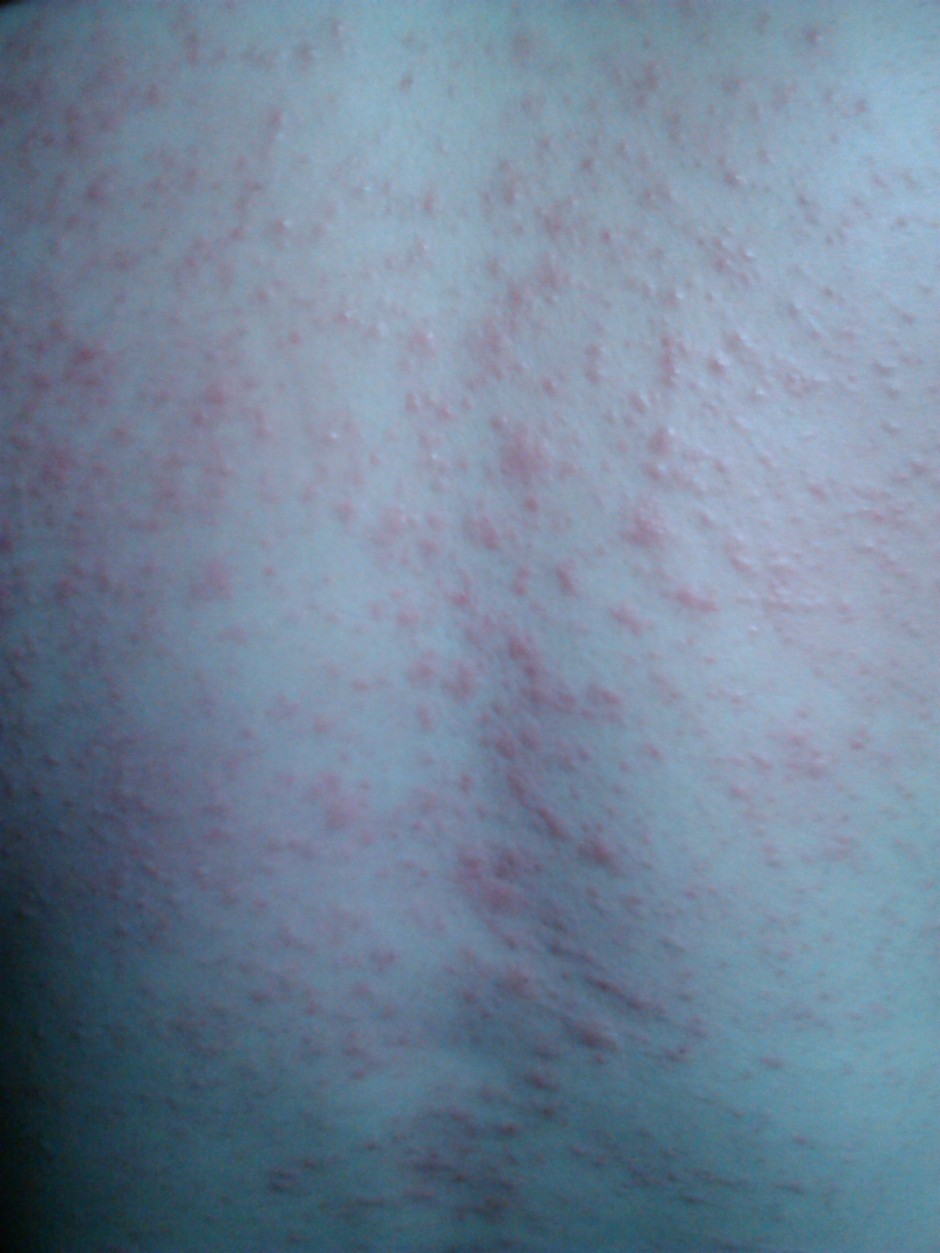 海鲜过敏怎么办 预防海鲜过敏的方法