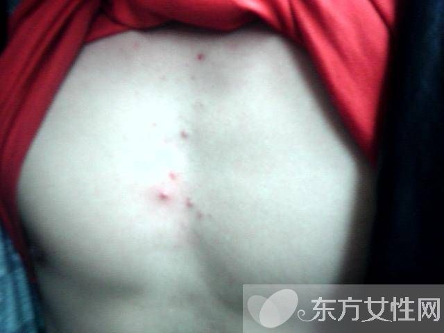 胸前长痘痘的原因有哪些　这些食疗方法很见效哦