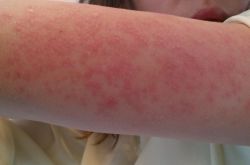 紫外线过敏怎么办 它有哪些症状表现