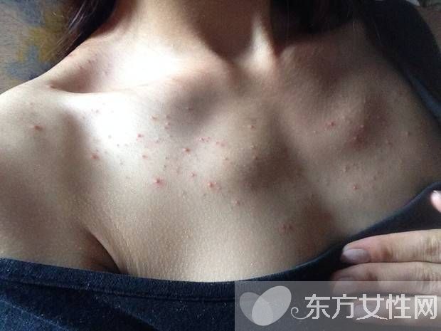 胸前长痘痘的原因有哪些　这些食疗方法很见效哦