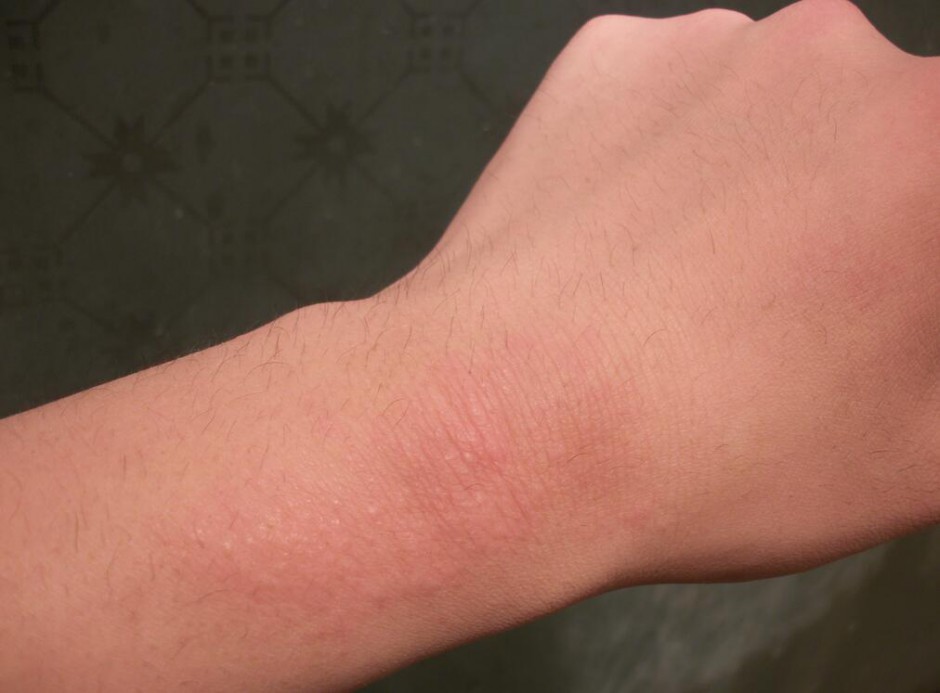 海鲜过敏怎么办 预防海鲜过敏的方法