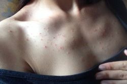 胸前长痘痘的原因有哪些　这些食疗方法很见效哦