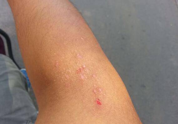 紫外线过敏怎么办 它有哪些症状表现