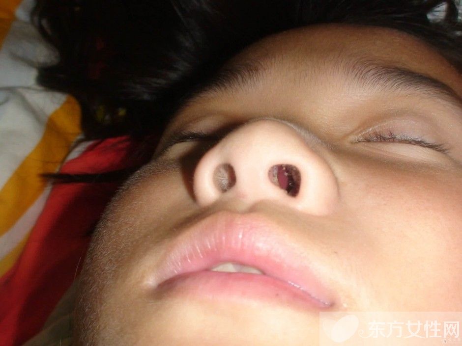 鼻子干疼怎么办 怎么预防和护理你的鼻子