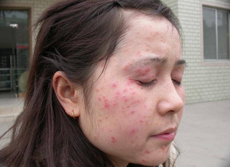 紫外线过敏怎么办 它有哪些症状表现