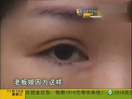 女子整形上班遭拒 割完双眼皮后眼睛吓人