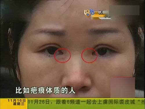 女子整形上班遭拒 割完双眼皮后眼睛吓人