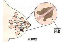 职场女性为什么乳腺癌高发 我们该如何爱护乳房