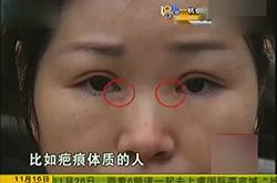 女子整形上班遭拒 割完双眼皮后眼睛吓人
