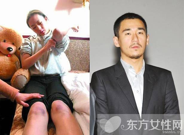 张默打伤女友童瑶事件始末 童谣个人资料