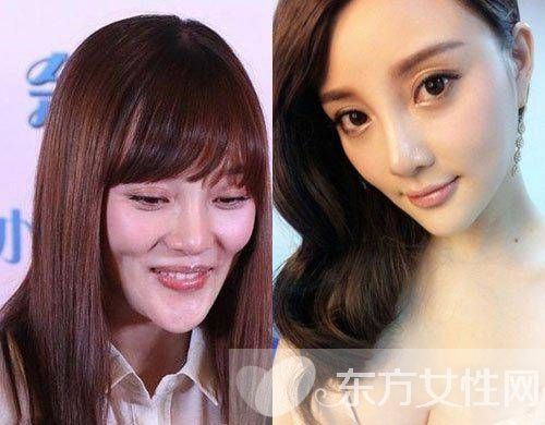 李小璐整容失败变脸瘫 老公贾乃亮力挺爱妻否认整容