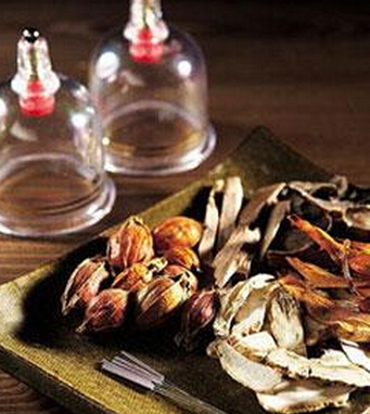 拔罐疗法 7类人群不适合拔罐减肥