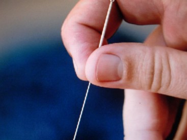 针灸减肥原理 针灸减肥反弹的快吗