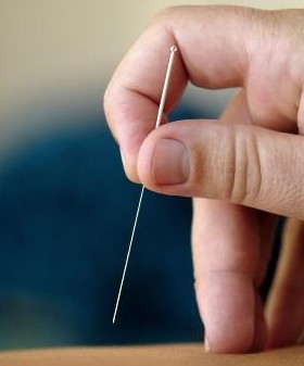 减肥方法 针灸减肥有哪些瘦身穴位