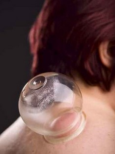 拔罐减肥 拔罐减肥的利与弊