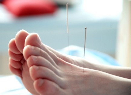 针灸减肥有效吗 用针灸减肥可瘦的体质介绍