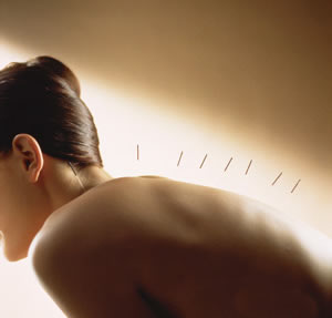 如何健康减肥 中医针灸减肥的优势有哪些