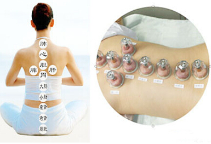 拔罐减肥法 减去体内深层多余脂肪