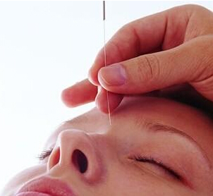 如何进行针灸减肥 针灸减肥应该注意什么
