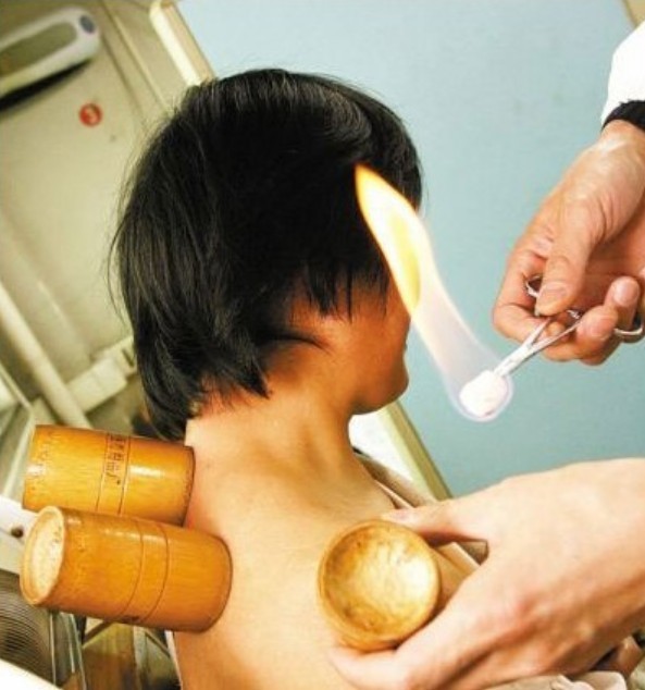 如何拔罐减肥 拔罐减肥施罐法的操作方法