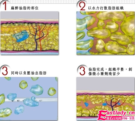 抽脂减肥有没有生命危险