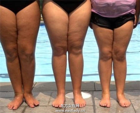 粗腿有三种 瘦腿方法大不同