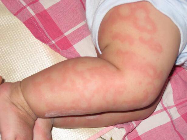 宝宝过敏怎么办 千万记住这三点