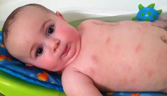 宝宝过敏怎么办 千万记住这三点