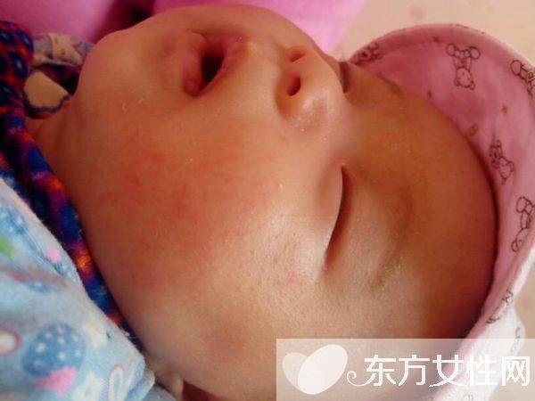 婴儿奶癣的症状表现 这么做可有效预防奶癣哦