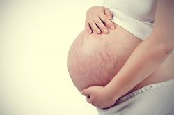 产后如何去掉妊娠纹 这些错误方法赶紧改过来