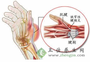 腱鞘炎怎么治疗 熏洗法治疗腱鞘炎