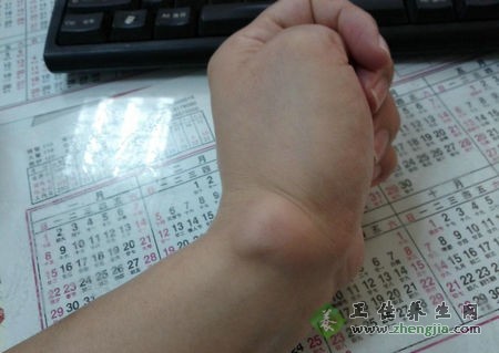 腱鞘炎怎么治疗 熏洗法治疗腱鞘炎