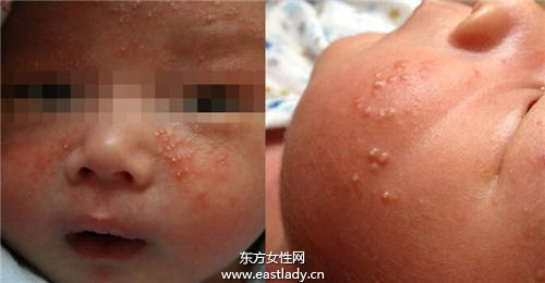 宝宝脸上长小疙瘩妈妈误以为是痱子 差点给宝宝毁容