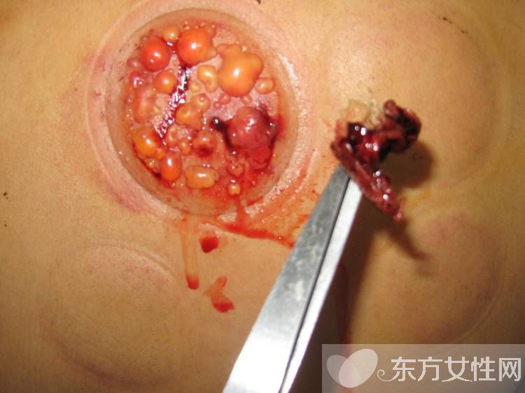 拔火罐减肥的好处与坏处 拔火罐减肥会反弹吗