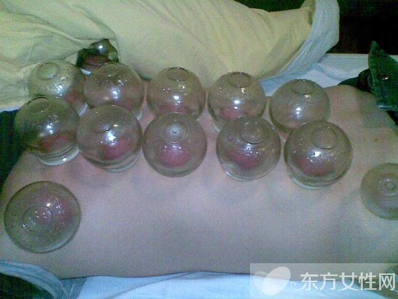 拔火罐减肥的好处与坏处 拔火罐减肥会反弹吗