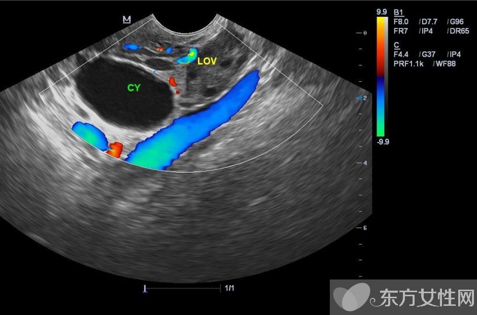 卵巢囊肿的最佳治疗 这些不良习惯易得卵巢囊肿哦