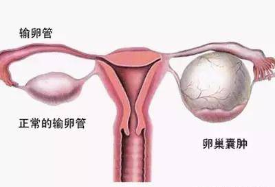卵巢囊肿的治疗方法有哪些 及时就医还你一生健康