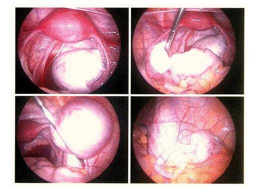 子宫内膜异位的症状有哪些 专家称这样预防
