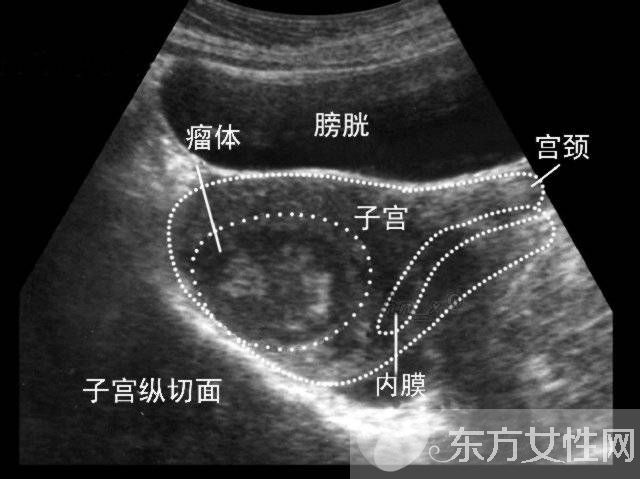 子宫肌瘤的症状表现 子宫肌瘤的危害居然这么大