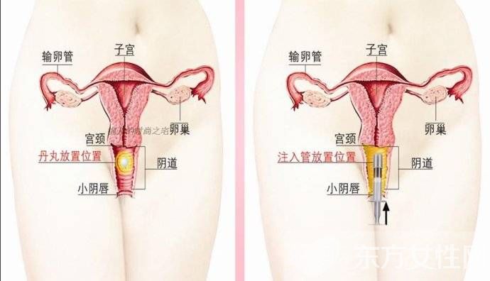 盆腔炎的症状与治疗方法 这些症状有可能是盆腔炎